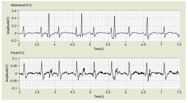 Fetal ECG Extraction Using LabVIEW - National Instruments